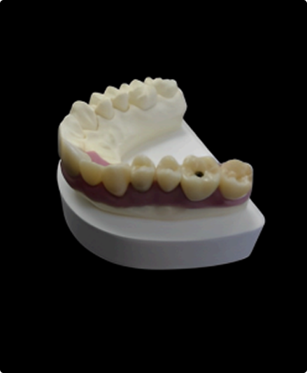 Implant-Supported Bridges